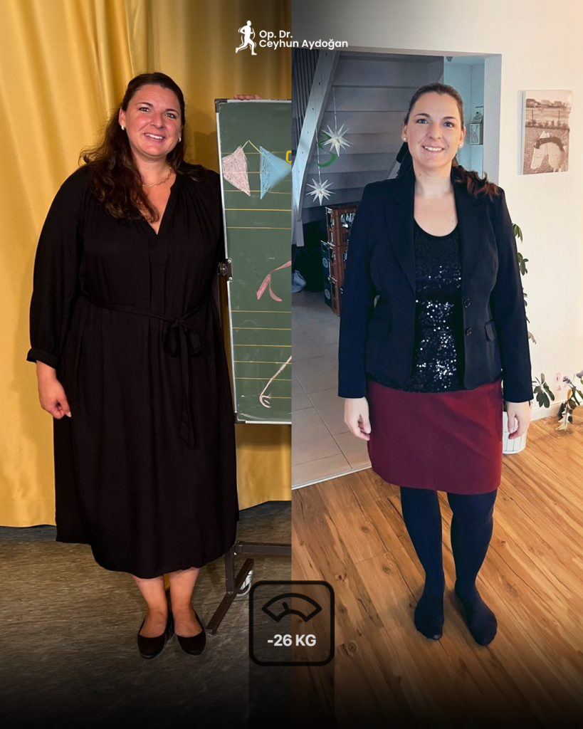 gastric-sleeve