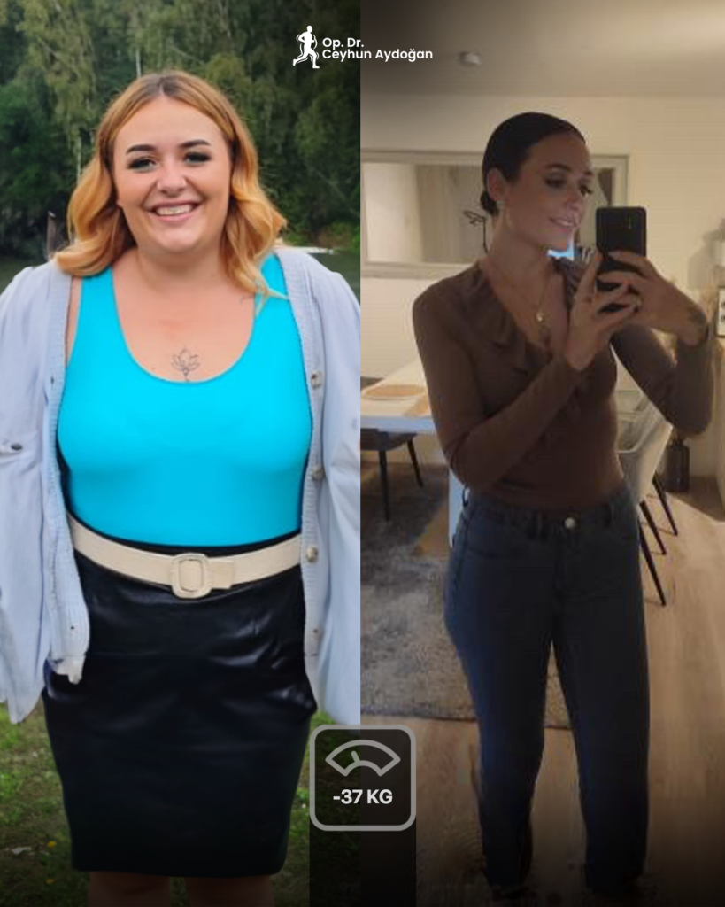 gastric-sleeve-before-after