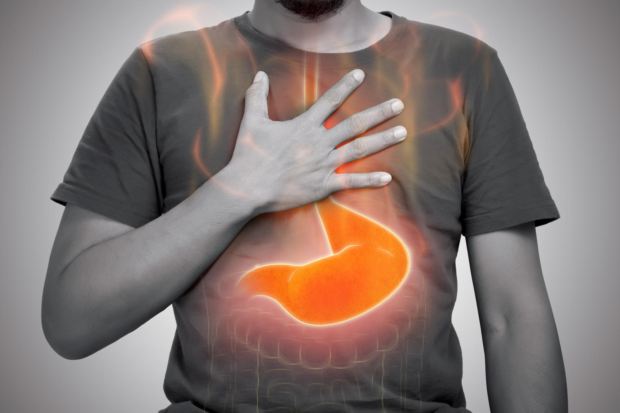 Heartburn After Sleeve Gastrectomy